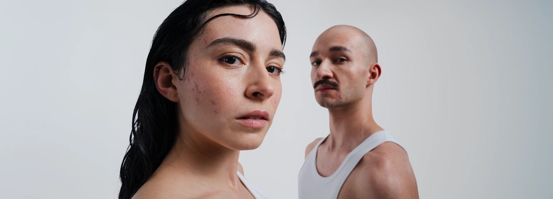 Zwei Personen mit sichtbaren Hautunreinheiten im Gesicht blicken in die Kamera und zeigen unterschiedliche Hautbilder mit Mitessern.