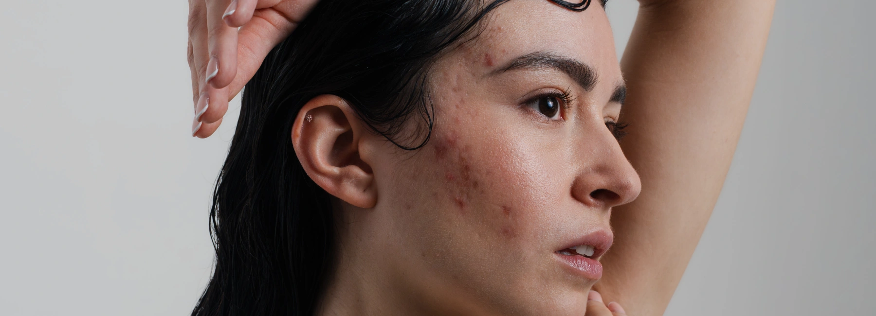 Pickelmale entfernen: Wie kann ich Pickelmale loswerden?