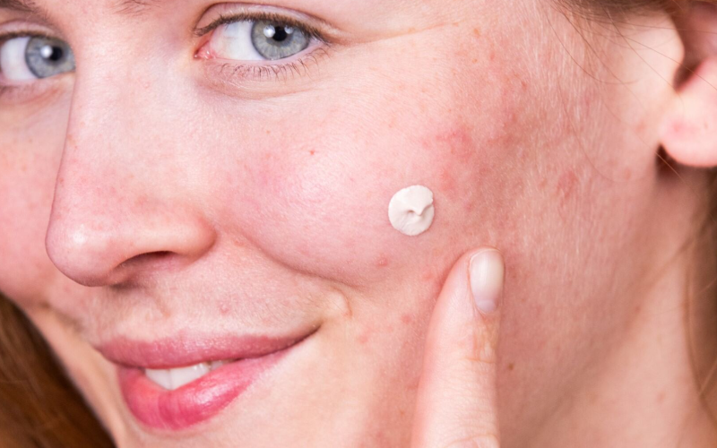 Person trägt ein Spot Treatment von Nø Cosmetics auf das Gesicht auf