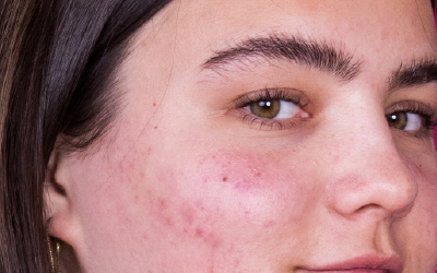 Gesicht mit dehydrierter Haut und Unreinheiten