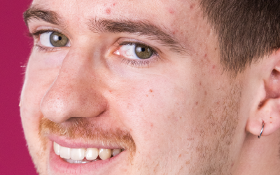 Gesicht mit öliger Haut und Unreinheiten