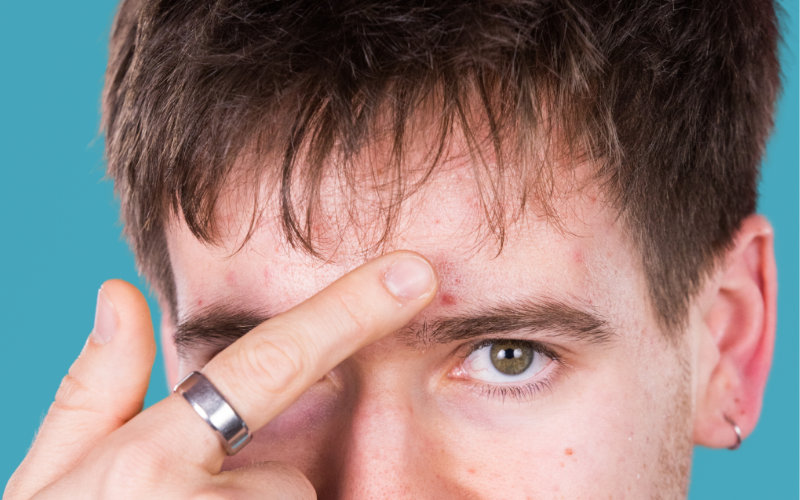 Person trägt das Invisible Spot Treatment auf Unreinheiten im Gesicht auf
